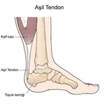 Aşil Tendonu Kopması Nasıl Olur, Tedavisi Nelerdir