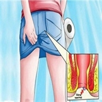 Hemoroid (Basur) Ağrısını Gidermenin 5 Yolu