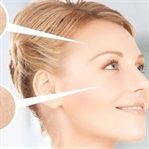 Derin cilt yenileme yöntemi, ‘’lazer peeling’’