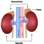 Adrenal Bez Tümör Kanseri İçin Tedavi Seçenekleri