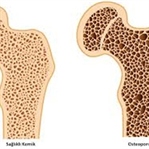 Kemik Erimesi (Osteoporoz) Durdurmanın Yolları