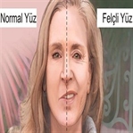 Yüz Felci Nasıl Geçer?