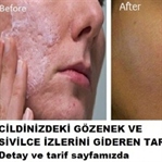 2 Kaşık karbonatla gözenek ve sivilceye son