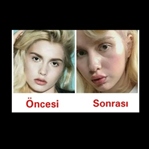 ALEYNA TİLKİNİN DUDAK ESTETİĞİ BİLMECESİ