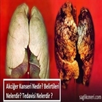 Akciğer Kanseri Nedir? Belirtileri & Tedavisi