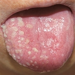 Herpes Enfeksiyonu Nedir, Belirtileri ve Tedavisi