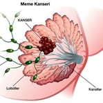 Meme Kanseri Teşhisi ve Tedavisi