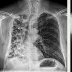 Bronşektazi(Bronş Genişlemesi) Nedir?