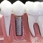 Implant Diş Nedir İmplant Diş Deneyimim