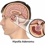 Hipofiz Adenomu için Kür