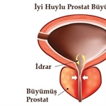 İyi Huylu Prostat için Kür
