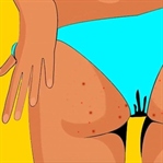 Bikini Bölgesi Sivilceleri Nasıl Engellenir?