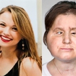 Yüz nakli yapılan en genç kişi Katie Stubblefield