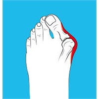Başparmak Çıkıntısı Nam-ı Diğer Hallux Valgus