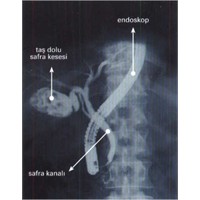 Ercp Nedir?