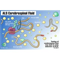 Als(Sinir Hastalığı) Nedir ? Tedavisi Var Mıdır ?