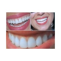 Diş Beyazlatma (Bleaching) Nedir, Nasıl Yapılır?