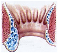 Hemoroid Hastalığı