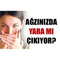 Ağız İçi Yaraları (Aft) Tedavisi