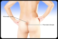 Pilonidal Kist