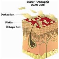 Sedef Hastalarına Dr. Çelakıl'dan Tavsiyeler