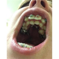 Hyperdontia Diş Bozukluğu