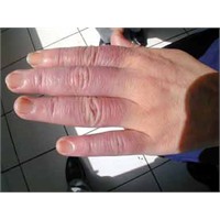 Sürekli Ellerim Üşüyor.. Raynaud Hastalığı