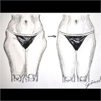 Lazer Liposuction Hakkında Herşey