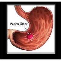 Peptik Ülser Hakkında Genel Bilgiler